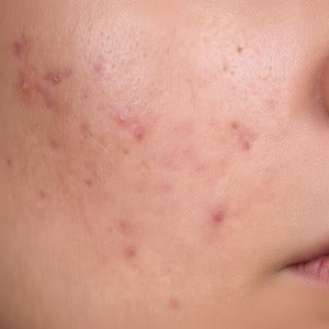 Painful, skin breakouts