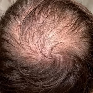 Brittle, thinning hair